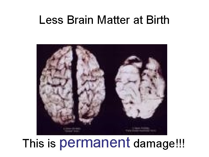 Less Brain Matter at Birth This is permanent damage!!! 