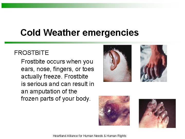 Cold Weather emergencies FROSTBITE Frostbite occurs when you ears, nose, fingers, or toes actually