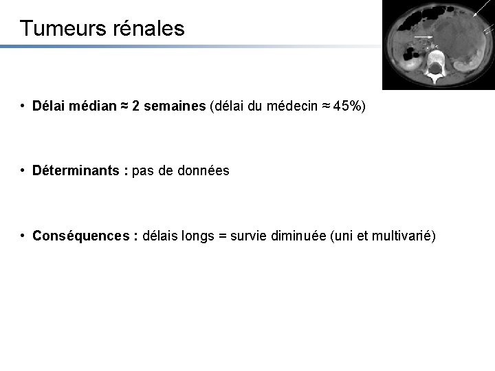 Tumeurs rénales • Délai médian ≈ 2 semaines (délai du médecin ≈ 45%) •