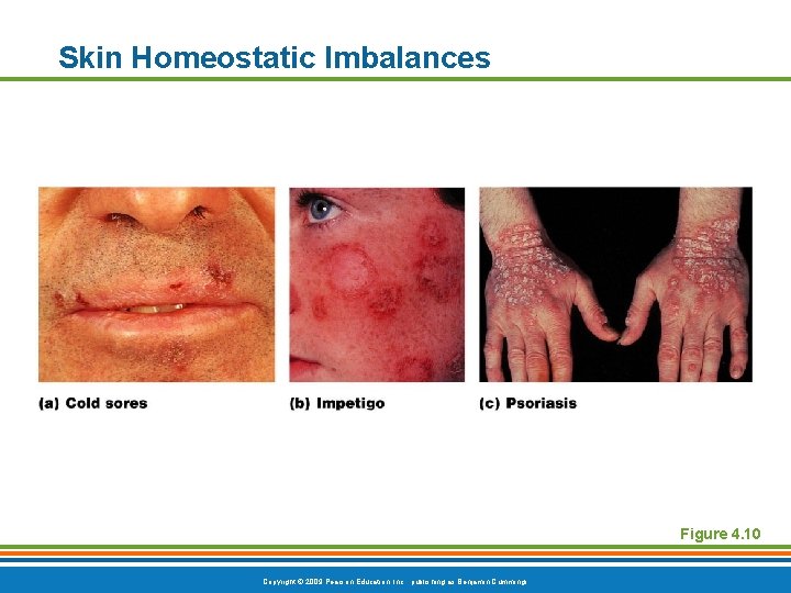 Skin Homeostatic Imbalances Figure 4. 10 Copyright © 2009 Pearson Education, Inc. , publishing