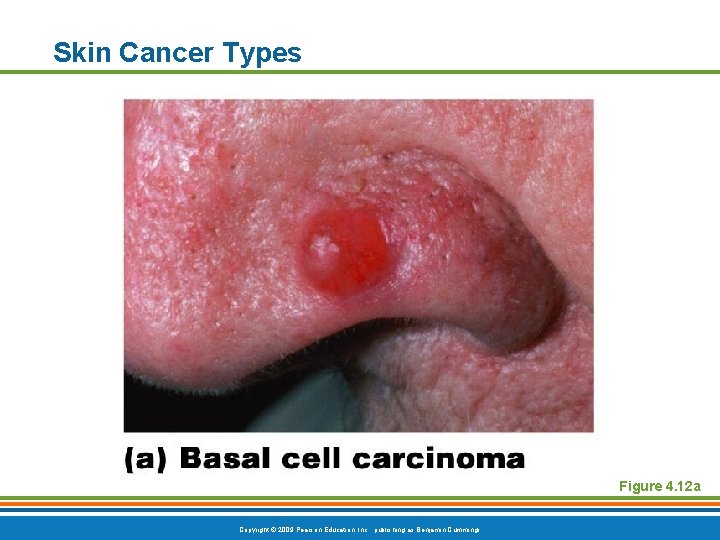 Skin Cancer Types Figure 4. 12 a Copyright © 2009 Pearson Education, Inc. ,