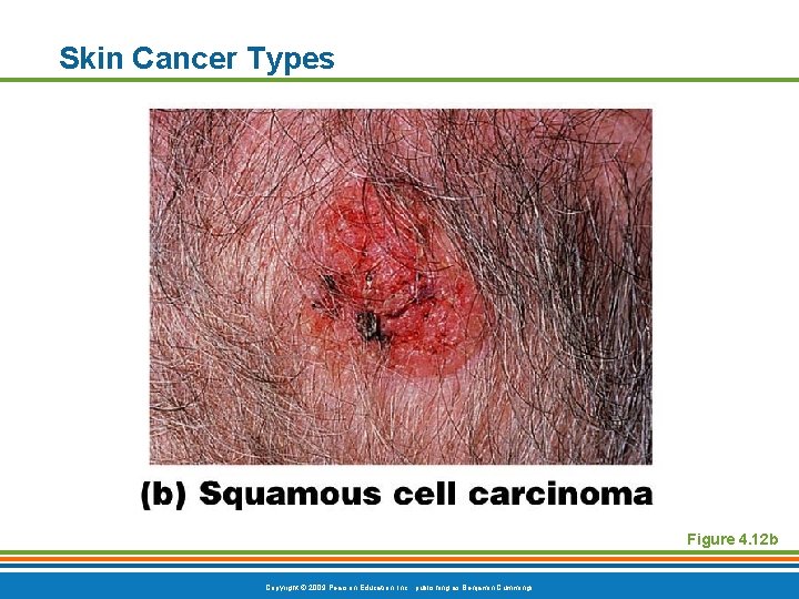 Skin Cancer Types Figure 4. 12 b Copyright © 2009 Pearson Education, Inc. ,