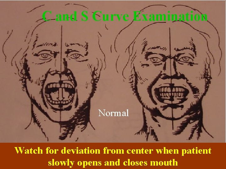 C and S Curve Examination Normal Watch for deviation from center when patient slowly