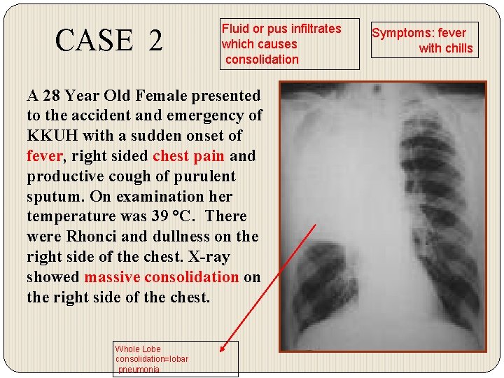 CASE 2 Fluid or pus infiltrates which causes consolidation A 28 Year Old Female