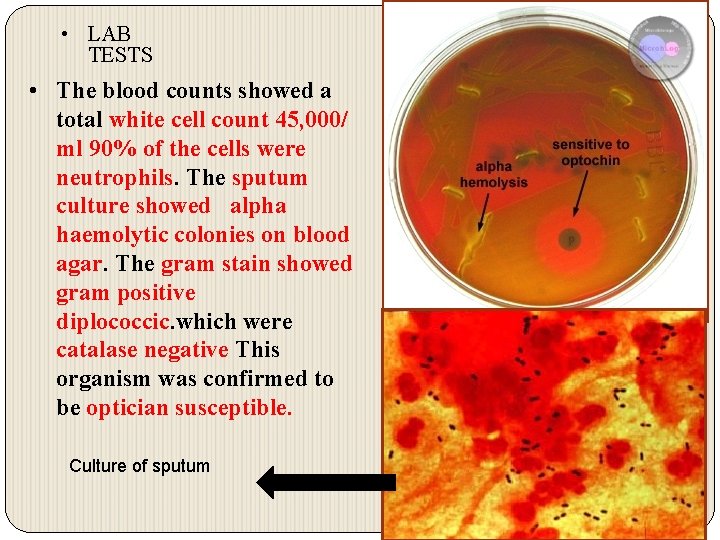  • LAB TESTS • The blood counts showed a total white cell count
