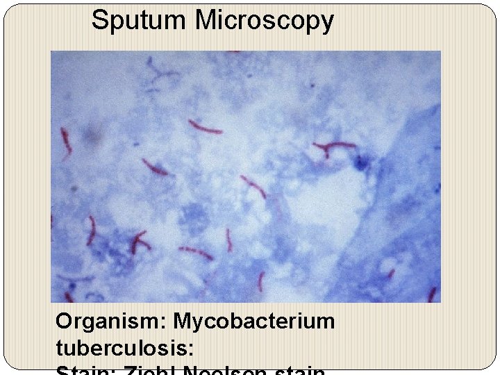 Sputum Microscopy Organism: Mycobacterium tuberculosis: 