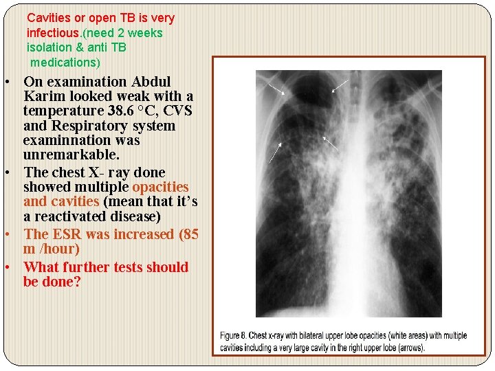 Cavities or open TB is very infectious. (need 2 weeks isolation & anti TB