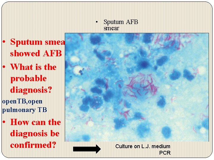  • Sputum AFB smear • Sputum smear showed AFB • What is the