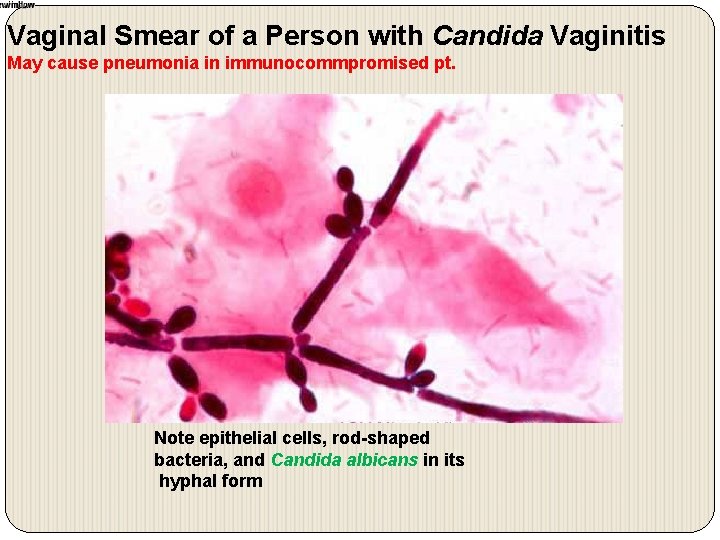 Vaginal Smear of a Person with Candida Vaginitis May cause pneumonia in immunocommpromised pt.