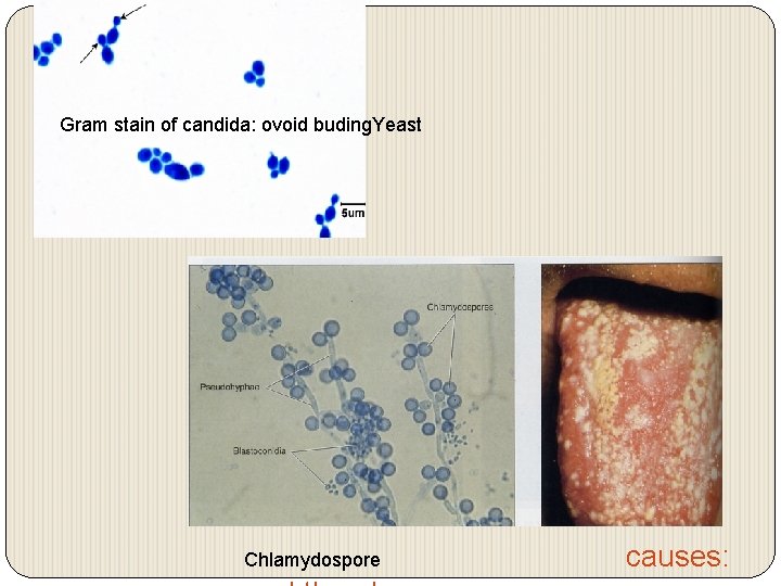 Gram stain of candida: ovoid buding. Yeast Chlamydospore causes: 