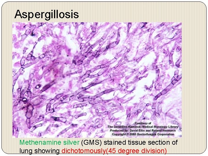 Aspergillosis Methenamine silver (GMS) stained tissue section of lung showing dichotomously(45 degree division) 