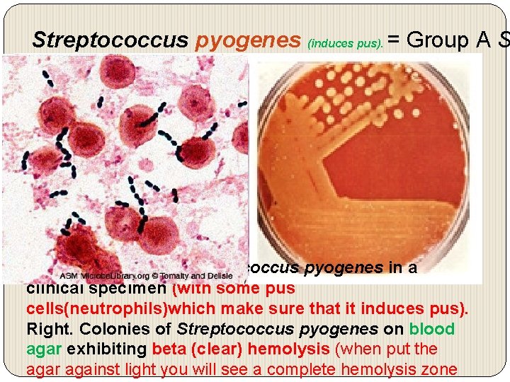 Streptococcus pyogenes (induces pus). = Group A S Left. Gram stain of Streptococcus pyogenes