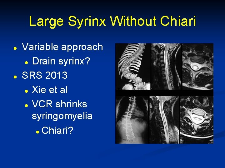 Large Syrinx Without Chiari l l Variable approach l Drain syrinx? SRS 2013 l