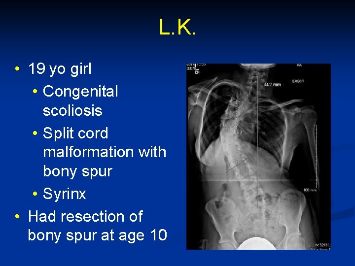 L. K. • 19 yo girl • Congenital scoliosis • Split cord malformation with