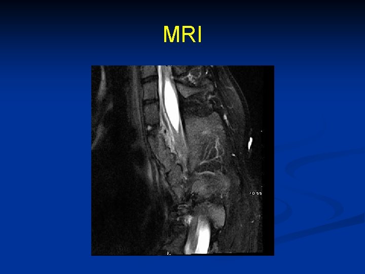 MRI Syringomyelia + Diastematomyelia 