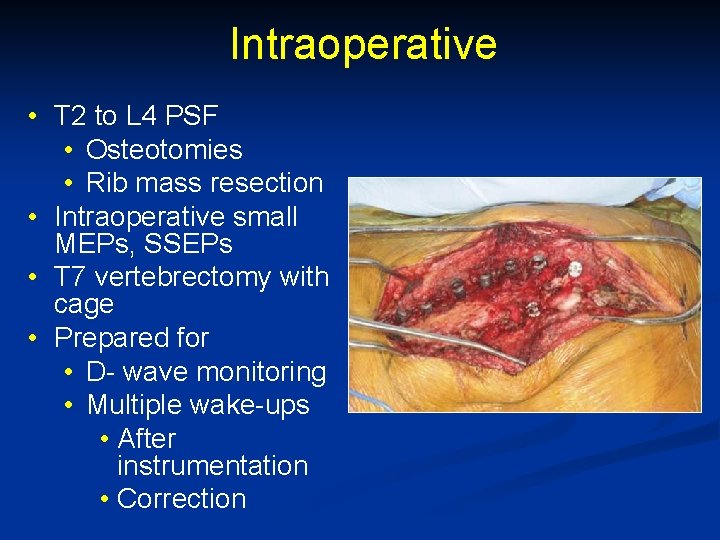 Intraoperative • T 2 to L 4 PSF • Osteotomies • Rib mass resection