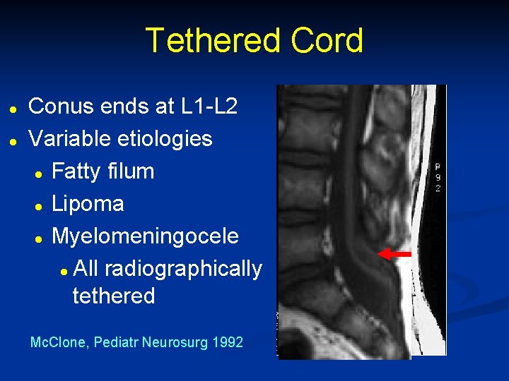 Tethered Cord l l Conus ends at L 1 -L 2 Variable etiologies l