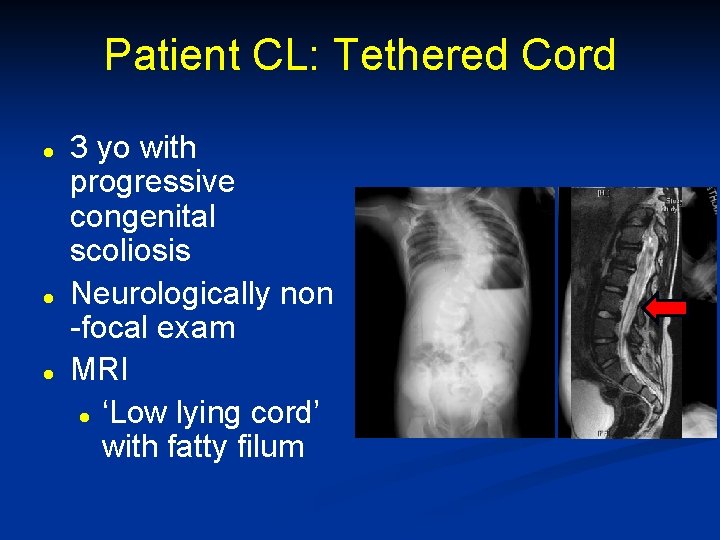 Patient CL: Tethered Cord l l l 3 yo with progressive congenital scoliosis Neurologically