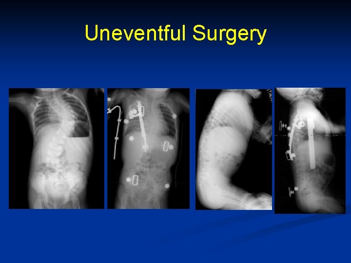 Uneventful Surgery 