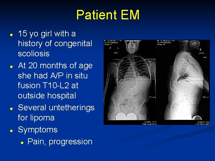 Patient EM l l 15 yo girl with a history of congenital scoliosis At