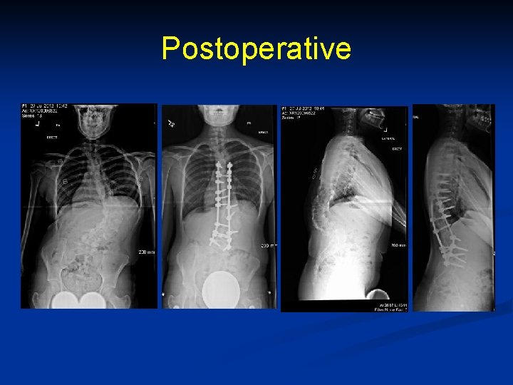 Postoperative 