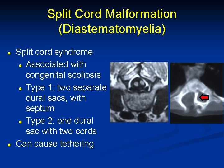 Split Cord Malformation (Diastematomyelia) l l Split cord syndrome l Associated with congenital scoliosis