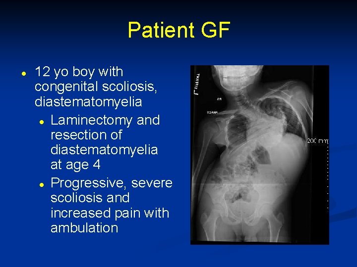 Patient GF l 12 yo boy with congenital scoliosis, diastematomyelia l Laminectomy and resection