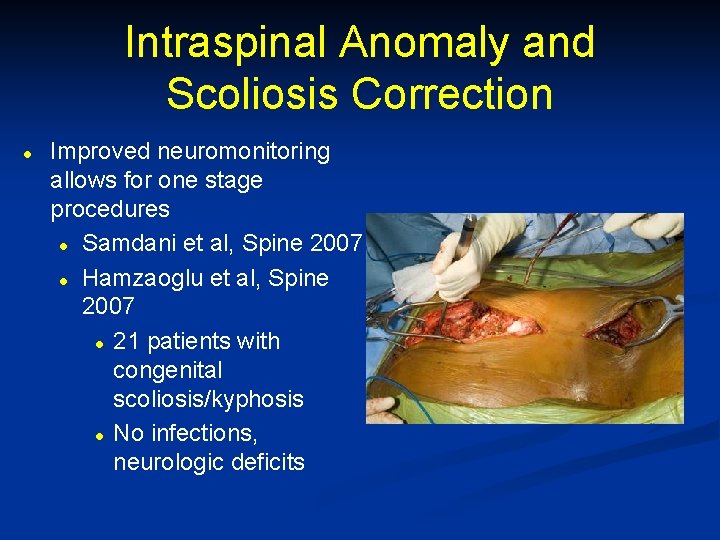Intraspinal Anomaly and Scoliosis Correction l Improved neuromonitoring allows for one stage procedures l