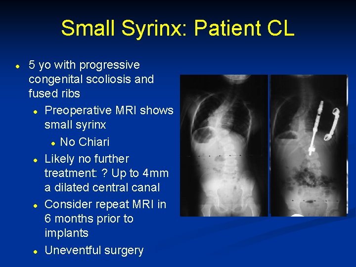 Small Syrinx: Patient CL l 5 yo with progressive congenital scoliosis and fused ribs