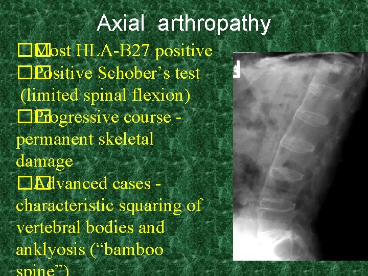 Axial arthropathy �� Most HLA-B 27 positive �� Positive Schober’s test (limited spinal flexion)