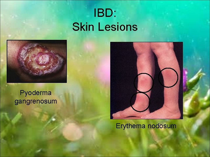 IBD: Skin Lesions Pyoderma gangrenosum Erythema nodosum 