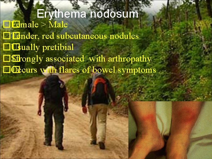 Erythema nodosum �� Female > Male �� Tender, red subcutaneous nodules �� Usually pretibial