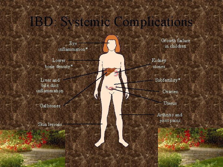 IBD: Systemic Complications Eye inflammation* Lower bone density* Liver and bile duct inflammation Gallstones