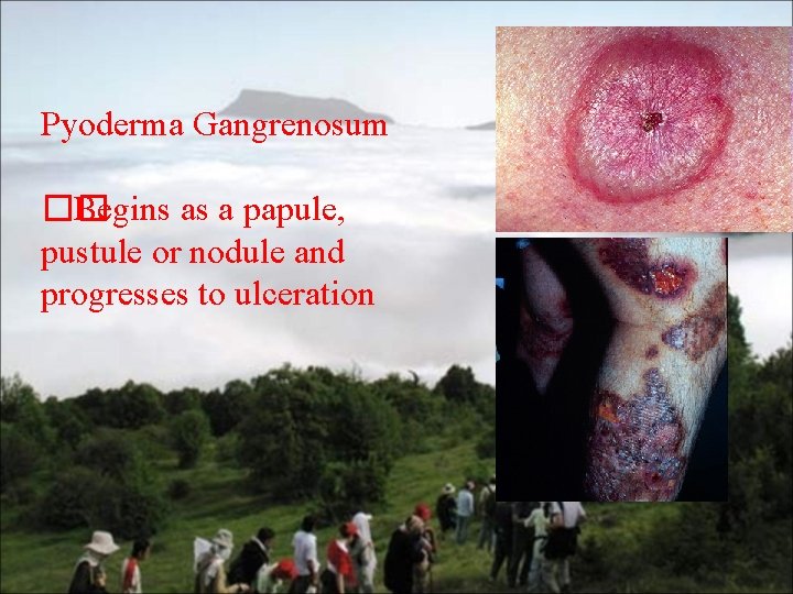 Pyoderma Gangrenosum �� Begins as a papule, pustule or nodule and progresses to ulceration