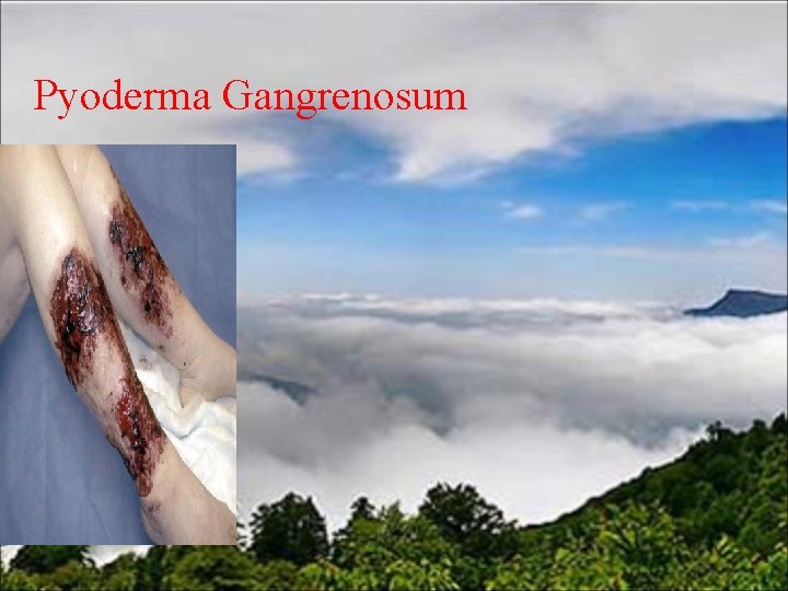 Pyoderma Gangrenosum 