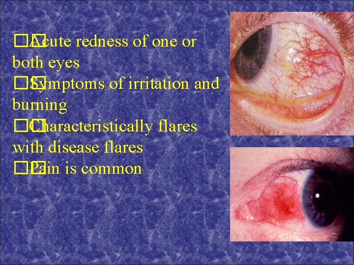 �� Acute redness of one or both eyes �� Symptoms of irritation and burning