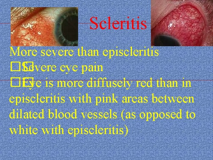 Scleritis More severe than episcleritis �� Severe eye pain �� Eye is more diffusely