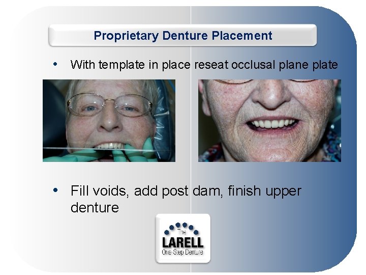 Proprietary Denture Placement • With template in place reseat occlusal plane plate • Fill