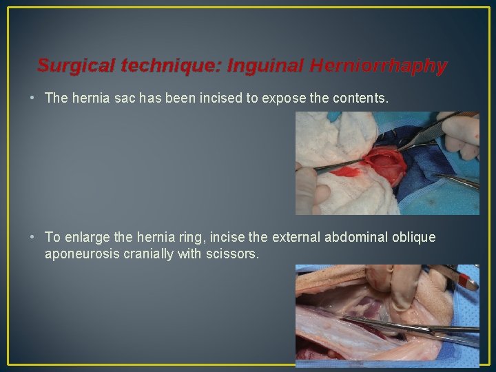 Surgical technique: Inguinal Herniorrhaphy • The hernia sac has been incised to expose the