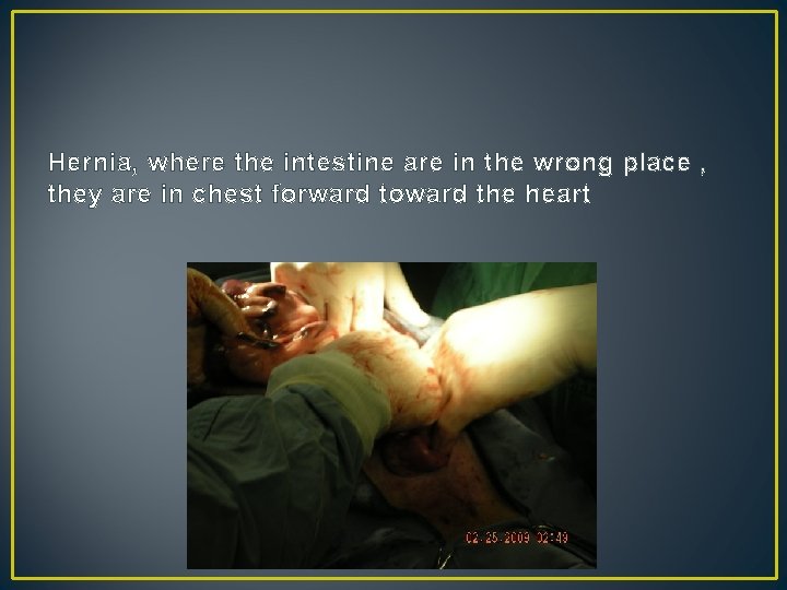 Hernia, where the intestine are in the wrong place , they are in chest