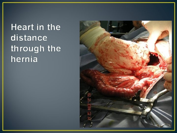 Heart in the distance through the hernia 