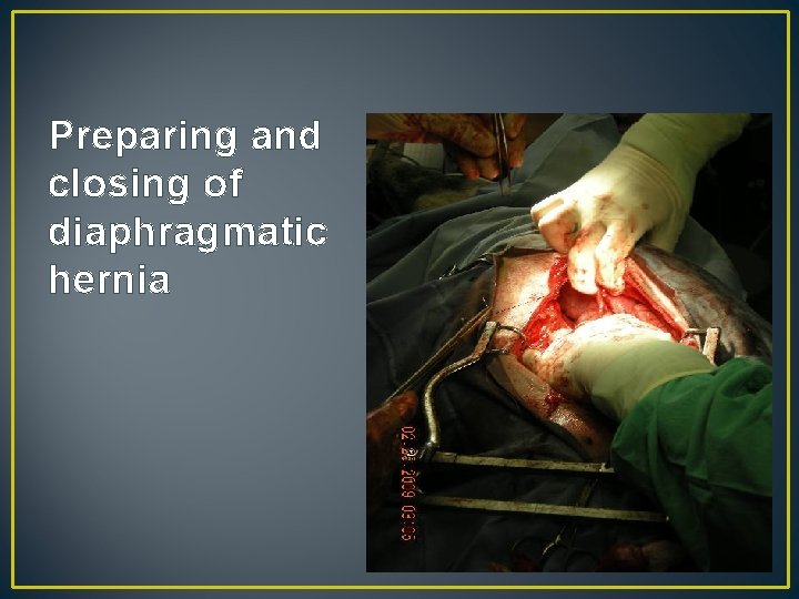 Preparing and closing of diaphragmatic hernia 