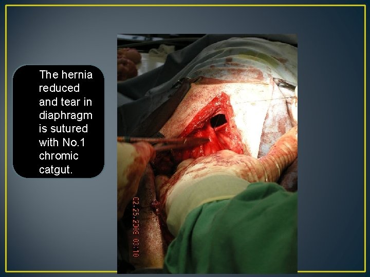 The hernia reduced and tear in diaphragm is sutured with No. 1 chromic catgut.