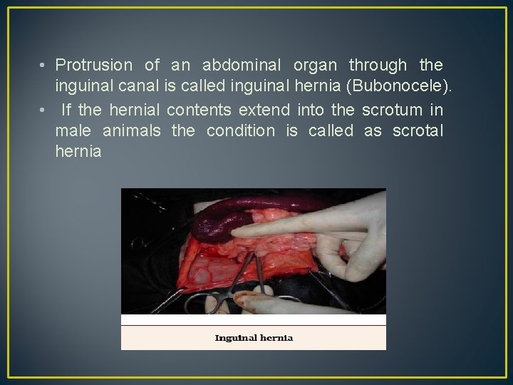 • Protrusion of an abdominal organ through the inguinal canal is called inguinal