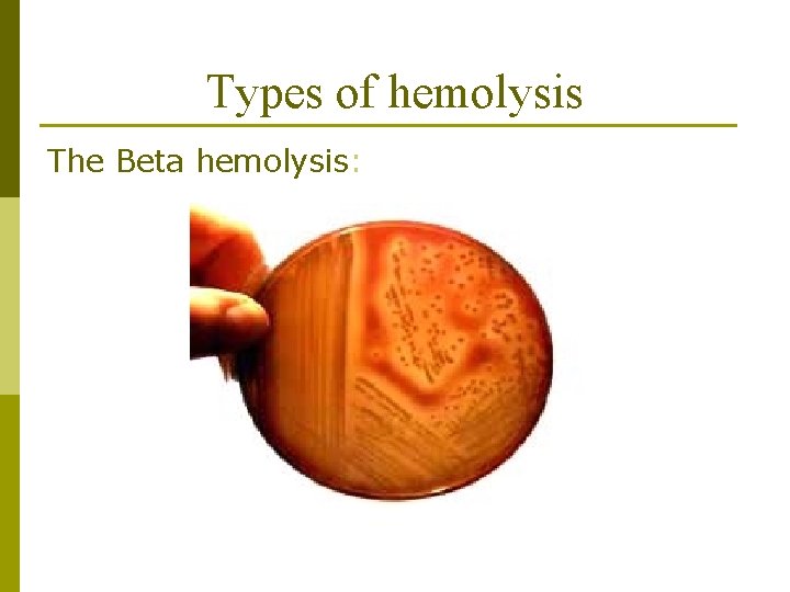 Types of hemolysis The Beta hemolysis: 