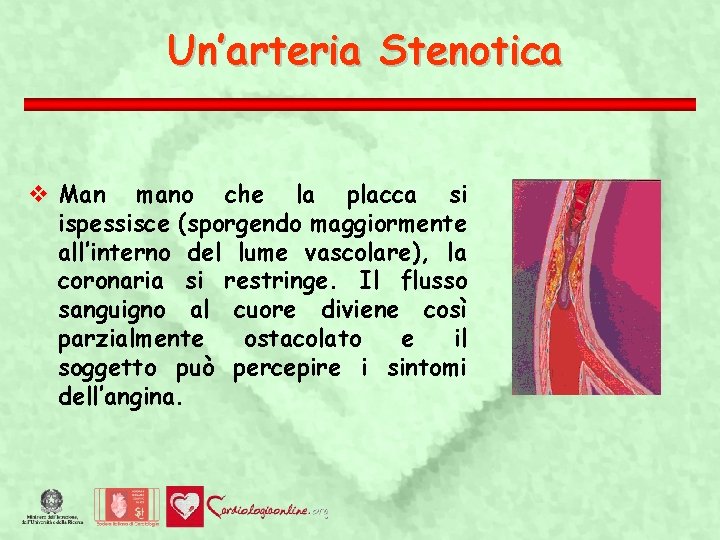 Un’arteria Stenotica Man mano che la placca si ispessisce (sporgendo maggiormente all’interno del lume