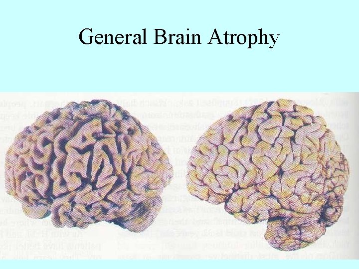 General Brain Atrophy 