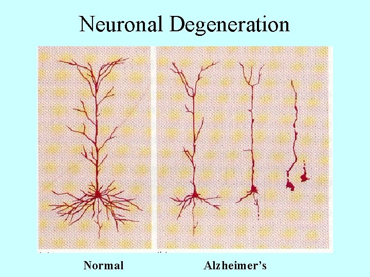 Neuronal Degeneration Normal Alzheimer’s 