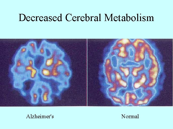 Decreased Cerebral Metabolism Alzheimer's Normal 