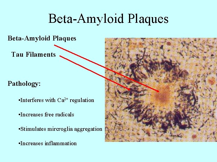 Beta-Amyloid Plaques Tau Filaments Pathology: • Interferes with Ca 2+ regulation • Increases free